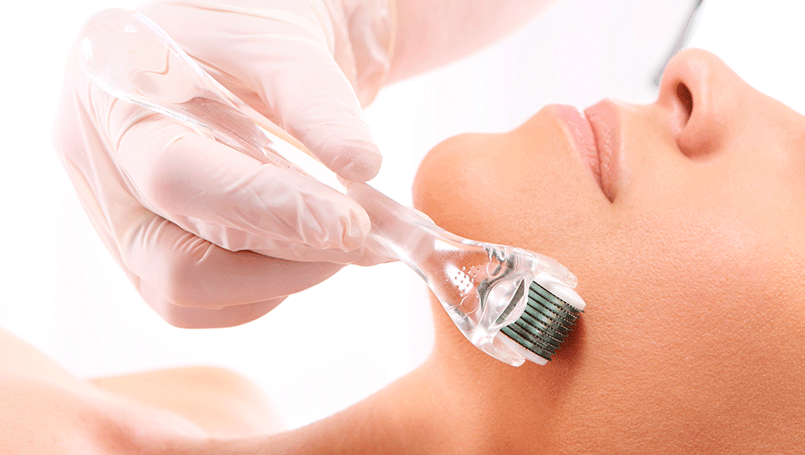 Microneedling